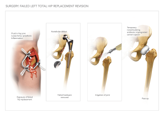 Failed Left Total Hip Replacement Revision