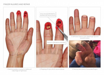 Finger Injuries and Repair