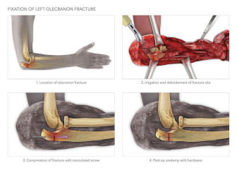 Fixation of Left Olecranion Fracture