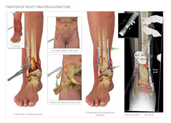 Fixation of Right Tibia/ Fibula Fracture and Proposed Amputation