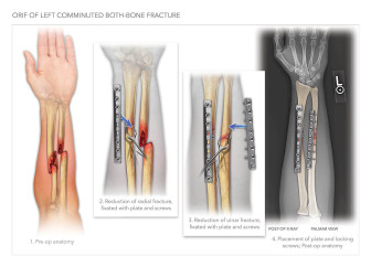 Forearm Injuries and Repair