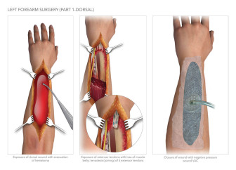 Forearm Surgery