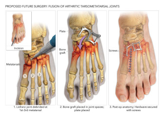 Fusion of Arthritic Tarsometatarsal Joints