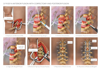 Fusion & Corpectomy