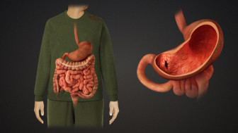 Gastrointestinal (GI) Anatomy with Gastric Ulcer