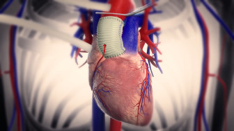 Heart Surgery Animation