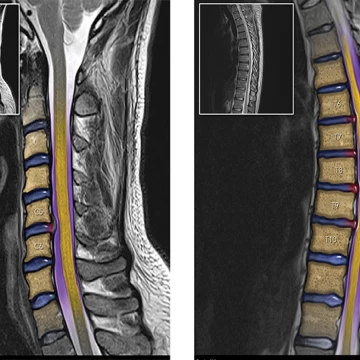 Colorized Mri Segment $395k Verdict On $9.9k Offer: Colorized MRIs Prove Liability