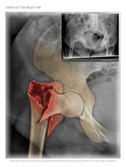 Hip Fracture Illustration
