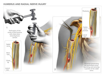 Humerus and Radial Nerve Injury