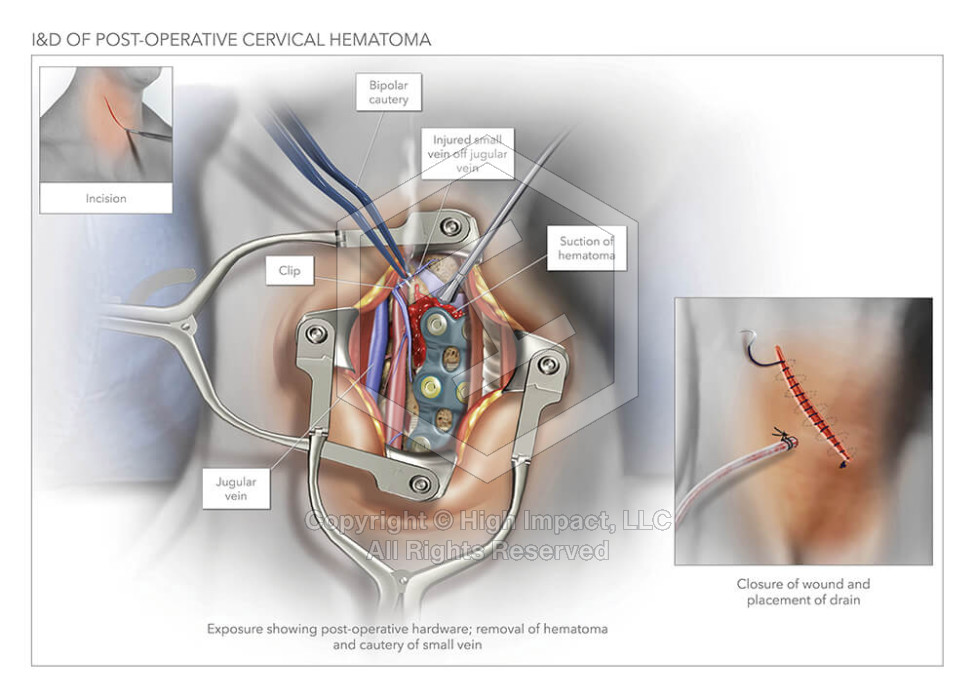I&D of Post-Operative Cervical Hematoma