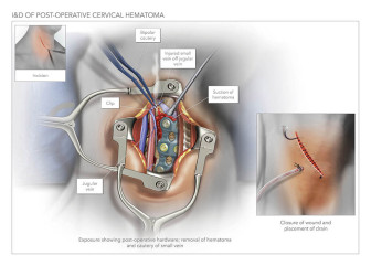 I&D of Post-Operative Cervical Hematoma