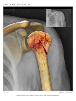 Impacted Humeral Neck Fracture