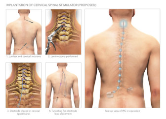 Implantation of Cervical Spinal Simulator (Proposed)