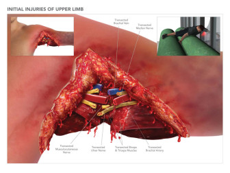 Injuries of Upper Limb