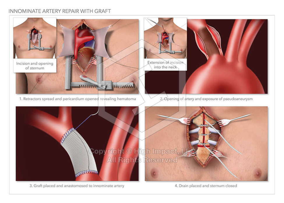 Innominate Artery Repair with Graft