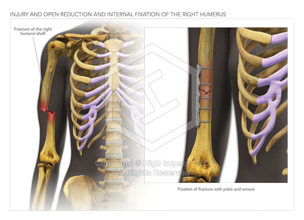 Internal Fixation of Humerus Fracture