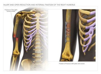 Internal Fixation of Humerus Fracture