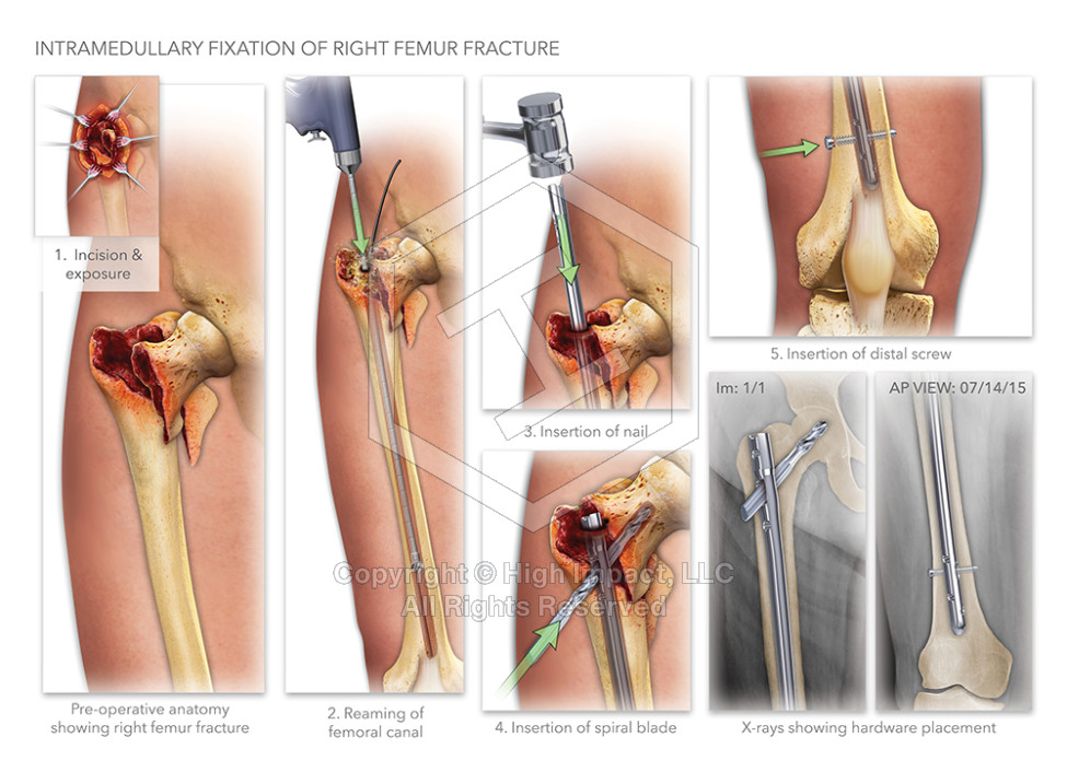 Intramedullary Fixation of Right Femur Fracture
