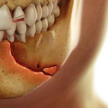 Mandibular fracture