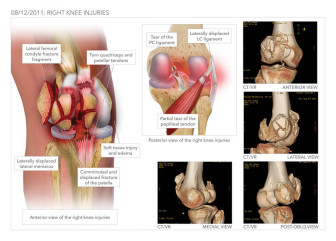 Knee Fracture and Surgeries