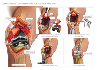Knee Replacement Revision