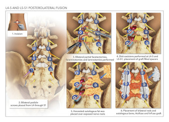 L4-5 and L5-S1 Posterolateral Fusion