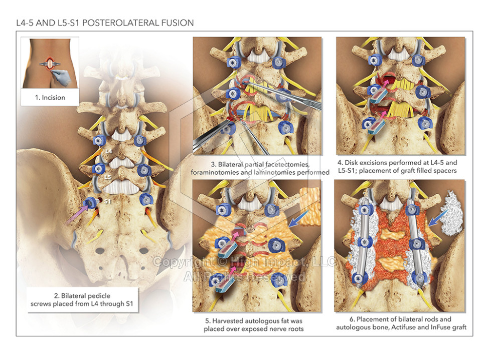 L4-5 and L5-S1 Posterolateral Fusion