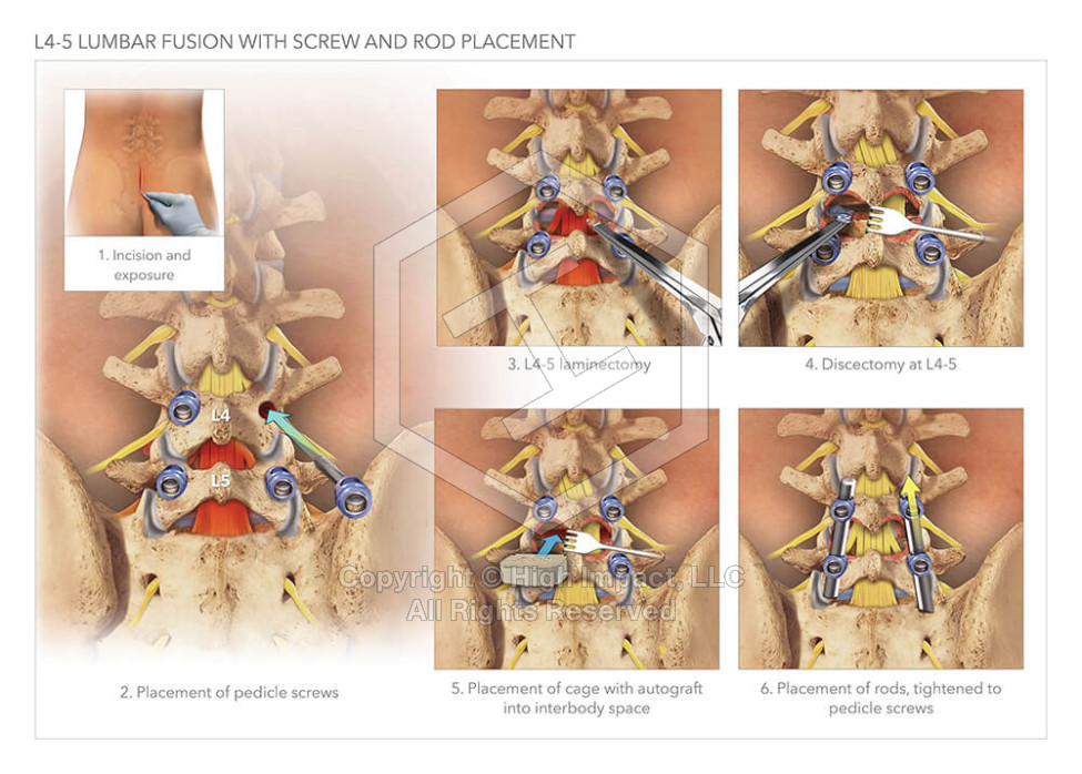L4-5 Lumbar Fusion with Screw and Rod Placement