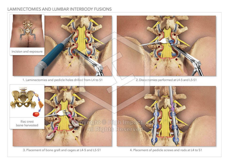 Laminectomies & Lumbar Interbody Fusions