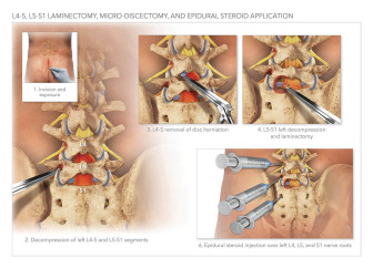 Laminectomy, Micro-Discectomy, and Epidural Steriod Application