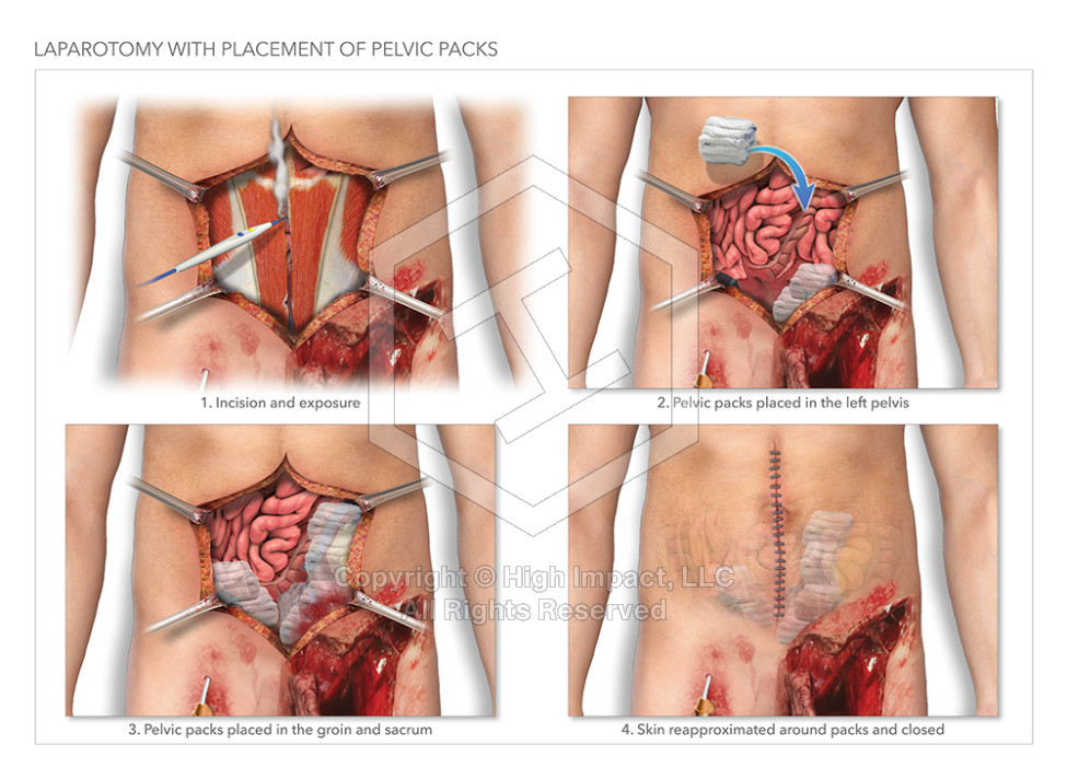 Laparotomy with Placement of Pelvic Packs