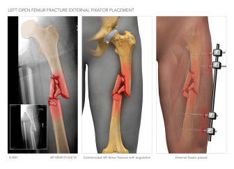 Left Femur Fracture and External Fixator Placement
