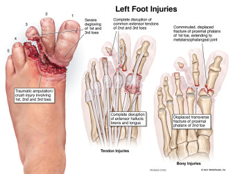 Left Foot Injuries