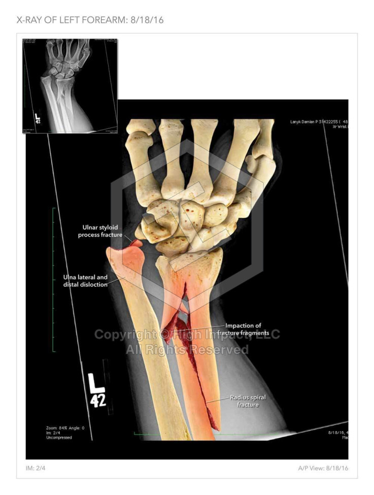 Left Forearm Fracture