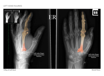 Left Hand Injuries