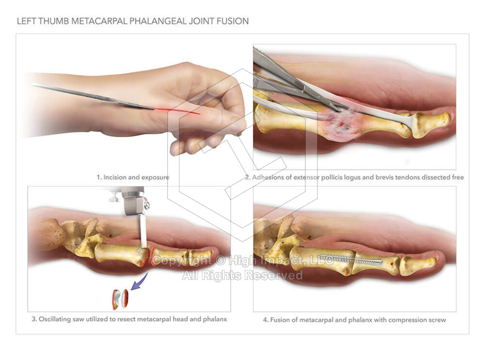 Left Thumb Metacarpal Phalangeal Joint Effusion