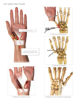 Left Wrist and Thumb