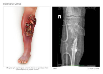 Leg Injuries with Amputation