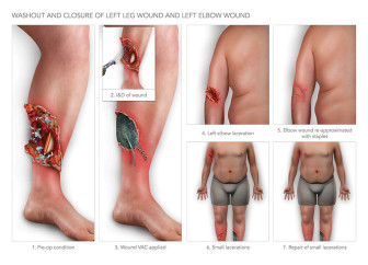 Leg Wound Procedures