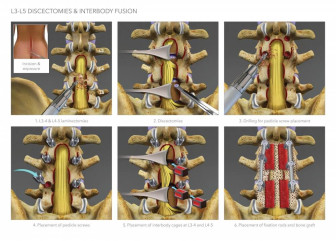 Lumbar Discectomies & Interbody Fusion
