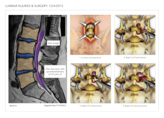 Lumbar Injuries & Surgery