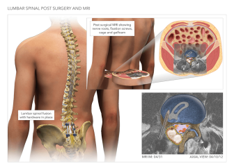Lumbar Spinal Post Surgery & MRI