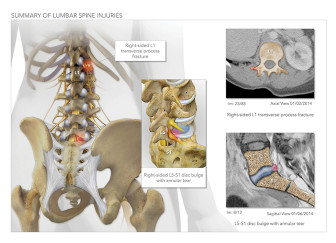 Lumbar Spine Fracture Illustration