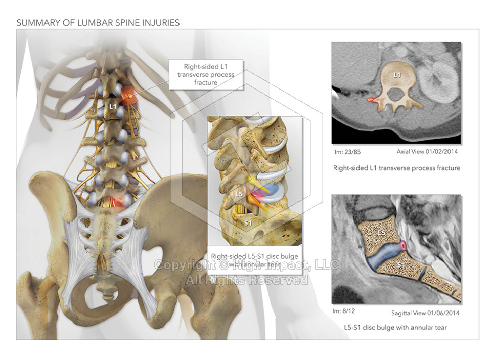 Lumbar Spine Fracture Illustration