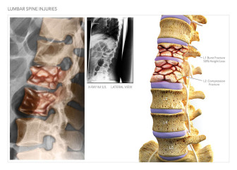 Lumbar Spine Injuries