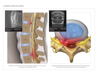 Lumbar Spine Injuries