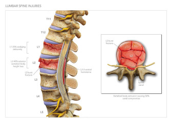 Lumbar Spine Injury Illustration
