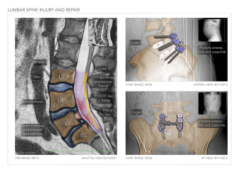 Lumbar Spine Injury and Repair