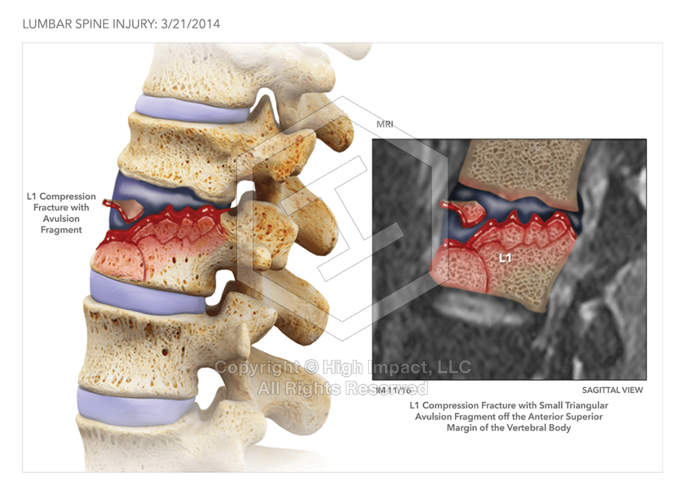 Lumbar Spine Injury
