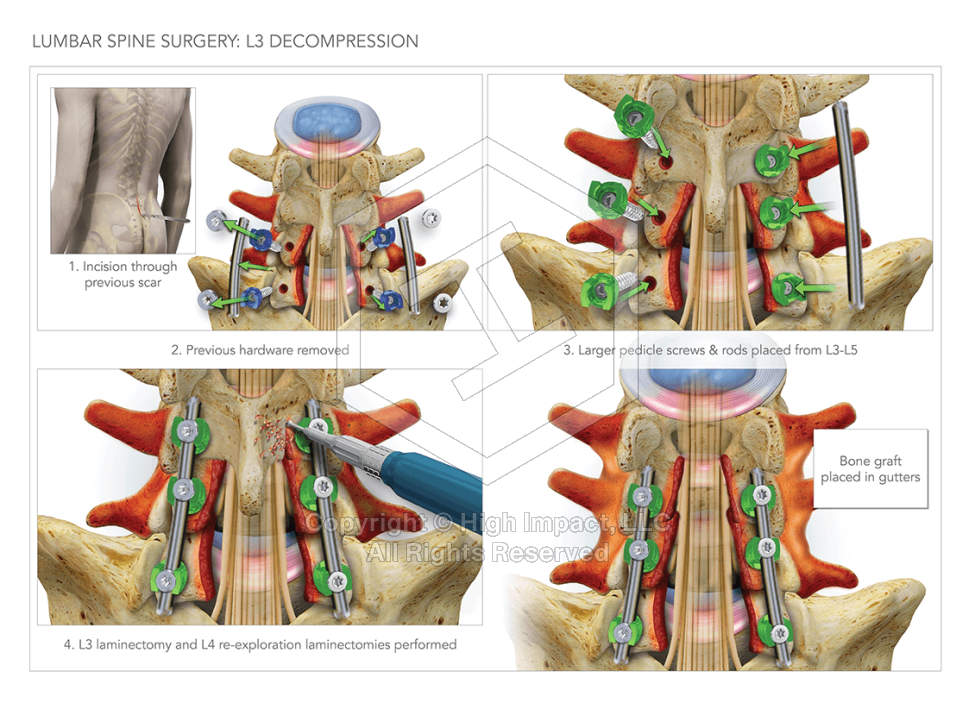 Lumbar Spine Surgery: L3 Decompression